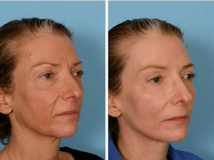 laser rejuvenation tupu mgbe ahụ