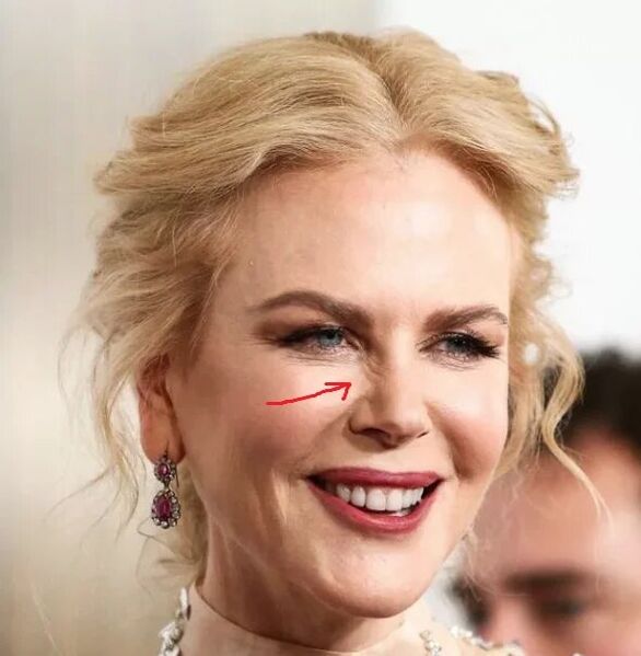 Ọzọ na botox