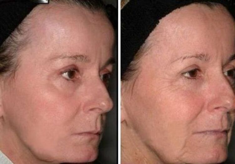 tupu na mgbe laser rejuvenation akpụkpọ ahụ foto 2