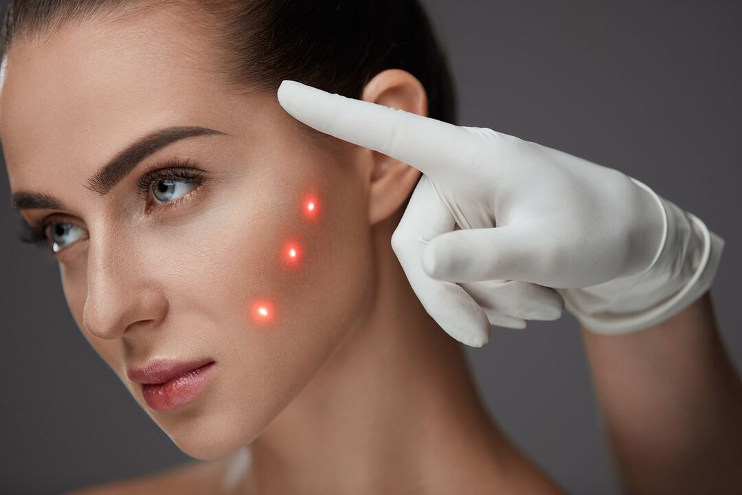 laser akpụkpọ rejuvenation